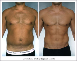 abdomens power assisted liposuction before after