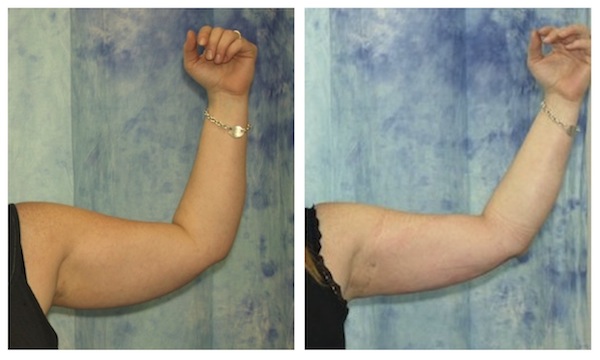 arms tickle lipo before after photo