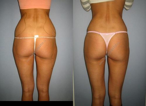 buttocks power assisted liposuction before and after