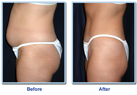 laser liposuction before and after photos: Abs