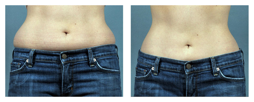 love handles tickle lipo before after photo