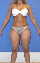 thighs power assisted liposuction before after