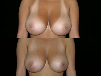 Breast Liposuction Before and After photos
