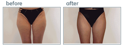 lipotherme hips and thighs before after photos