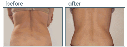 lipotherme waist before after photos