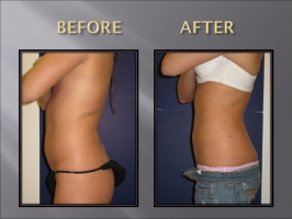 smart lipo abdomens before and after
