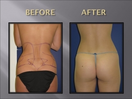 smart lipo love handles before and after photo