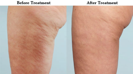 cellulaze before and after photo