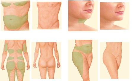 liposuction by body areas Photo