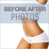 Liposuction Before  and After