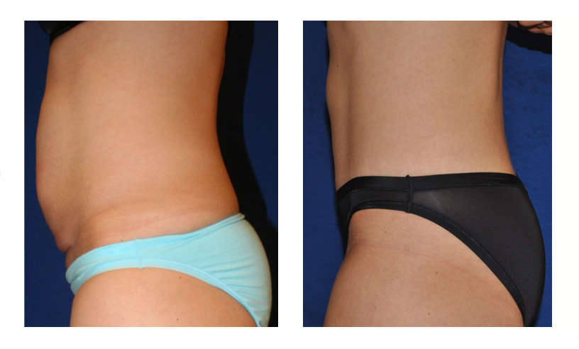 coolsculpting belly before after photos