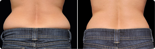 coolsculpting love handles before after photos