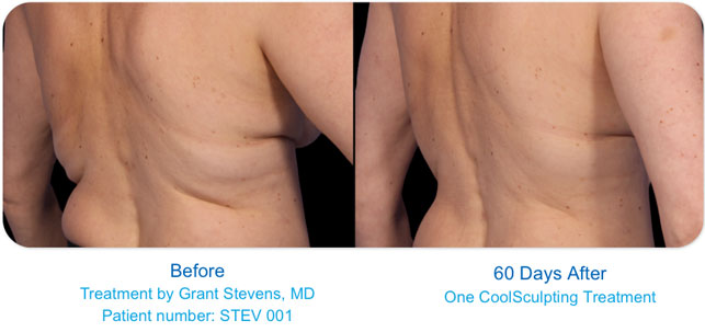 coolsculpting back before after photos