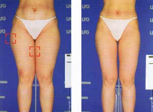 Endermologie Before After Photos - Thighs