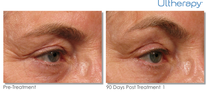 Ultherapy Before and After Photos - Eyes