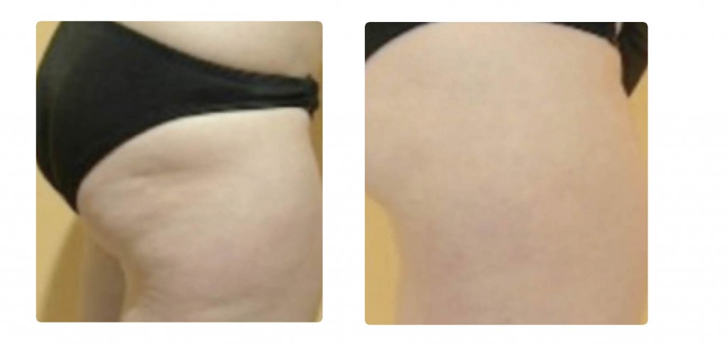 i lipo ultra before and after thighs