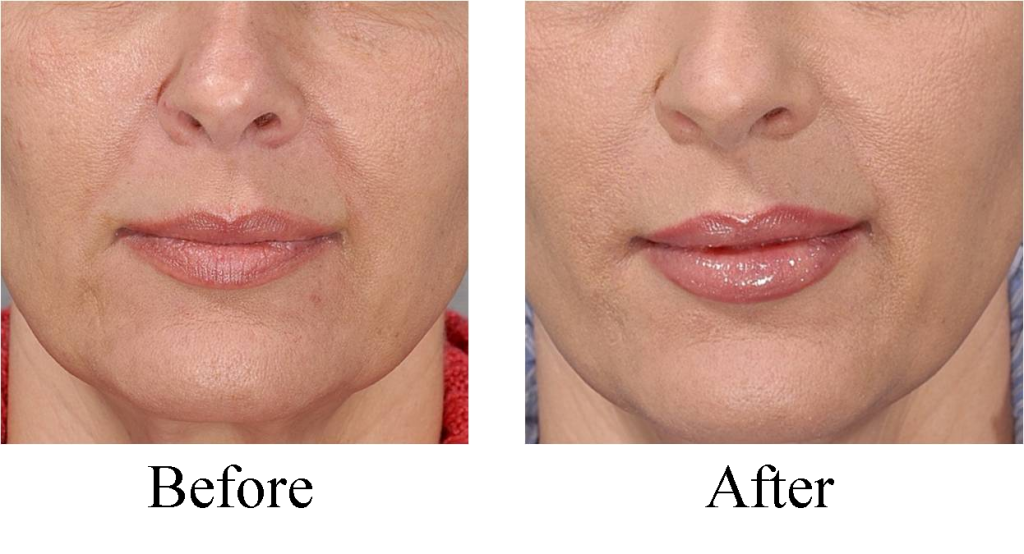 juvederm before after