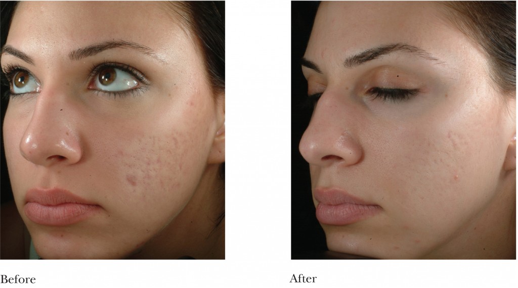 microdermabrasion before after 2